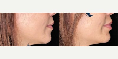 Woman treated with Lip Fillers - Woman treated with Lip Fillers.
