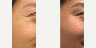 25-34 year old woman treated with Botox - Botox for Crows feet