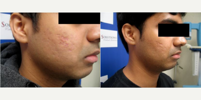 Man treated with Microneedling - Man treated with Microneedling.