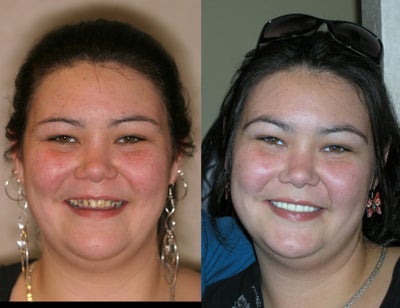 Dental All Porcelain Crowns -
This is a young lady that had a severe bacterial infection causing her teeth to decay. She became very self conscious and stopped smiling. She was also in pain and her teeth became very sensitive. After the procedure her gums healed and the teeth were stabilized by resurfacing them with porcelain. She now has strong teeth that look beautiful and she smiles all the time.