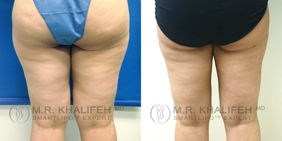 35-44 year old woman treated with Tumescent Liposuction - The inner thighs are a major cause of concern for many of our patients. a typical treatment will place incisions in the front of the groin and in the butt fold from behind, to make sure we get front and back.