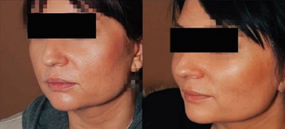 Patient treated with Cheek Lift - Great option to address early aging and face reshaping - absolutely no visible scars, none