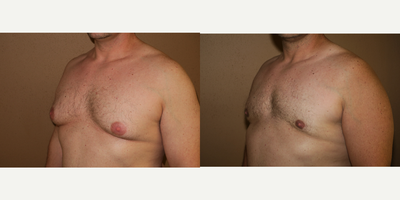 35-44 year old man treated with Male Breast Reduction - gynecomastia correction