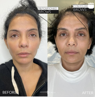Woman treated with Thread Lift - Woman treated with Thread Lift