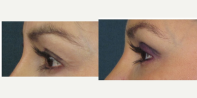 45-54 year old woman treated with Eyelid Surgery - Upper eyelid surgery