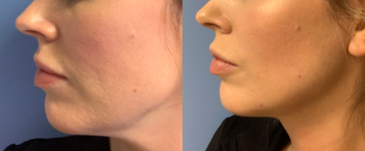 25-34 year old woman treated with Restylane on Cheek and Lip filler - This patient had a total of 3 syringes put in. She had 1 syringe of filler in each cheek bone area and one in the lip. Injecting the cheek area is a great way to lift the skin and help to sharpen the jawline.