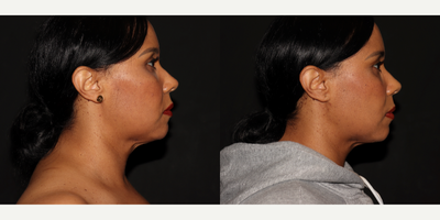 35-44 year old woman treated with Nonsurgical Facelift, Renuvion, Laser Liposuction - Liposuction to lower face and neck, renuvion to lower face and neck, MyEllevate