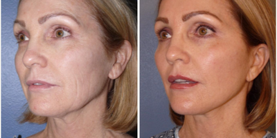 Woman treated with Laser Resurfacing - Woman treated with Facelift andNeck Lift with extended SMAS as well assmall amount ofFacial Fat Transfer, and CO2 Laser Resurfacing. Post-op, she had improved appearance in her jowls, cheeks, jawline, as well as her skin texture.