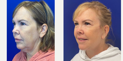 55-64 year old woman treated with Facelift, Neck Lift, Facial Fat Transfer, CO2 Laser - 59 years old 5 weeks after Facelift, Neck lift, and CO2 laser.