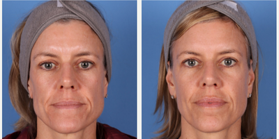 45-54 year old woman treated with Bellafill - 1 kit (5 syringes of Bellafill) for cheek volume restoration