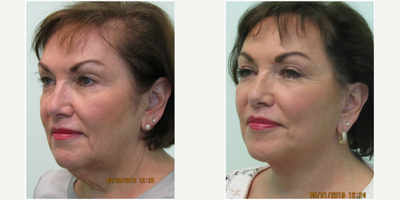 55-64 year old woman treated with Lower Face Lift, Necklift, and Upper Eyelid Blepharoplasty - This woman presented with significant laxity (looseness) of her neck and jawline after losing significant weight (over 40 lbs.) over the past year. She noticed a significant turkey neck and jowling as she lost her weight. She was also interested in removing the hooding over her eyelids which had been a concern of her for a few years. Maintaining a natural appearance was important for her, and she made it known during our initial consultation. We together agreed upon performing a lower facelift and necklift, along with an upper blepharoplasty. Both procedures were performed in our Center under local anesthesia utilizing only valium administered orally. Total procedure time was under three hours and most of her sutures were removed 6 days after procedure.Her results demonstrate a smoother jawline along with a significant reduction in the tissue (skin/fat/muscle) under her chin. Her eyelids are also less heavy appearing and more open.