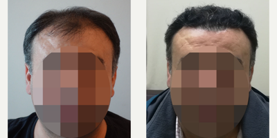 45-54 year old man treated with Hair Transplant - 3327 Grafts