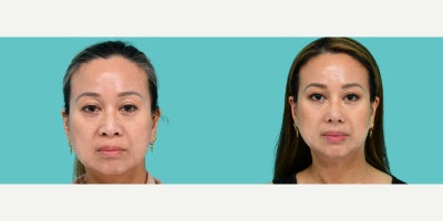 45-54 year old woman treated with Asian Rhinoplasty, Rhinoplasty - There are many approaches to rhinoplasty. My patient had been contemplating her options and wanted a more refined, projected tipwithout altering the character of her nose. Maintaining authenticity was her top priority, and at just 3 months post-op, its clear we achieved that. The enhanced tip projection and definition created a truly transformational improvement from every angle. Thats how important proper nasal tip projection is in facial aesthetics.