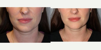 35-44 year old woman treated with Kybella - 35 y/o F, 130lb1 vial of kybella injections, 2mL