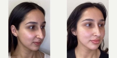 35-44 year old woman treated with Revanesse - This patient came in seeking overall balance of the face, refining the nose with liquid rhinoplasty as well as creating rejuvenation throughout the face with filler balanced conservatively, including enhancing the lips. Using Revanesse Versa filler, we focused on enhancing her existing features while maintaining balance. The nose tip has been lifted as aligned with the client's goals, and her full face appears beautifully balanced and brightened. Every treatment at Citrus Aesthetics is guided by ethics, safety, anatomical knowledge, intention of meeting clients unique goals, and a commitment to natural outcomes.