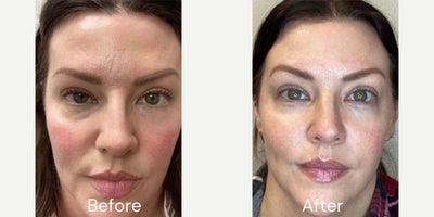 35-44 year old woman treated with SkinPen, Microneedling - This patient came in seeking improvement of skin texture, pore size and the wrinkle between her eyebrows (commonly known as the 11s. Using SkinPen microneedling, which creates lots of micro-puncture injuries, leading to collagen production and new and improved skin. SkinPen is FDA cleared and one of the most applications micro needling devices, creating 1,900 little puncture sites in one second. Pre-numbing is completed in clinic with a high medical grade numbing cream so that every client is very comfortable and pain-free. Every treatment at Citrus Aesthetics is guided by ethics, safety, anatomical knowledge, intention of meeting clients unique goals, and a commitment to natural outcomes.