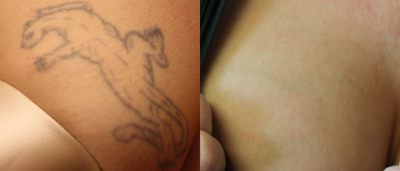 35-44 year old woman treated with Tattoo Removal - This patient was treated 4 times for this removal.