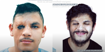 25-34 year old man treated with Beard Transplant, FUE Hair Transplant, Hair Transplant - Dr. Us expertise enables him to overcome even the most challenging patient goals. In this particular example, normal beard growth already existed on the left side of the face. However, the patient was born with a large congenital nevus covering much of the right half of his face. At a young age, he underwent a series of surgeries that replaced the dark regions with skin grafts taken from his neck. These new areas were not capable of producing beard hair which mirrored his left side. He sought Dr. Us help to reconstruct a perfectly symmetrical beard on both sides of his face. To complete the patients beard growth, Dr. U needed to study the left half of the face carefully. Secondly, he found it necessary to match the hair thickness that was already present. Scalp hair could not be used because it was far too thick. This would have produced an unnatural hair thickness on the right side compared to the left.Instead, he could attain softer hair types from the patients legs and nape, using the specialized intuitive features of his Dr.UGraft technology.Also, in this case, the newly reconstructed beard would help to camouflage the seams from the edges of the skin graft so that it would be less visible. Dr. U redesigned the patients beard contours on both sides of the face so that their peaks would project further inward to camouflage the linear scarring more fully.Dr.U inserted every donor graft by laying each one of the hair follicles as flat as possible according to the patterning set forth by nature. He also reserved the softest hairs for the very outer transition edges of the beard. The coarser nape hairs were inserted to then fill in the central regions of the recipient areas. Before doing so, he carefully studied the patients beard hair patterning present on the left half of his face. He then replicated these lessons to produce a mirror-like symmetry that would complete the patients overall beard.