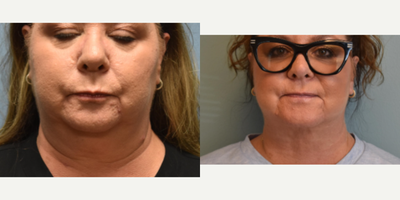 55-64 year old woman treated with Chin Liposuction - 57 year old female 6 months post Chin Liposuction.