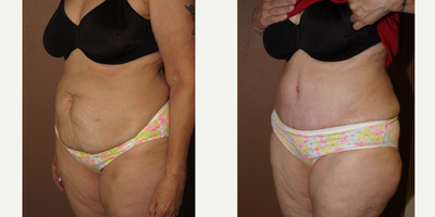 55-64 year old woman treated with Tummy Tuck - Tummy tuck and liposuction