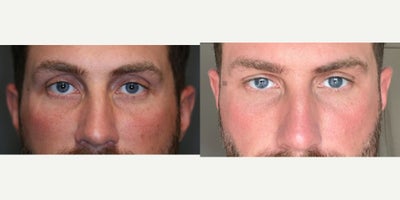 Upper Eyelid Volume - Filler to add volume and soften upper eyelids.