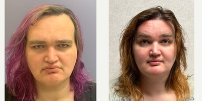 25-34 year old woman treated with Forehead Reduction, Brow Bone Reduction, Brow Lift, Septoplasty, Cheek Augmentation, Genioplas - This young lady underwent forehead feminization, blepharoplasty, septorhinoplasty, cheek augmentation, and genioplasty.