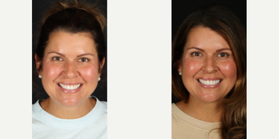 Woman treated with Porcelain Veneers - Exposed root surfaces and early fracture lines due to teeth clenching were covered and protected by completing a 10 veneer, natural smile makeover
