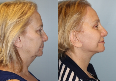 Woman treated with Neck Lift - Woman treated with Neck Lift