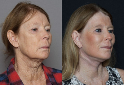 Woman in her 60s treated with Neck Lift - Woman in her 60s treated with Neck Lift to rejuvenate her look and improve skin texture. She was also treated with Facelift and Laser Resurfacing Treatment.