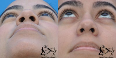 25-34 year old woman treated with Alarplasty - 25-34 year old woman treated with Alarplasty using weir excisions