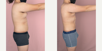 18-24 year old man treated with Abdominal Etching - This young patient is shown 2 months after an abdominal high definition liposuction.