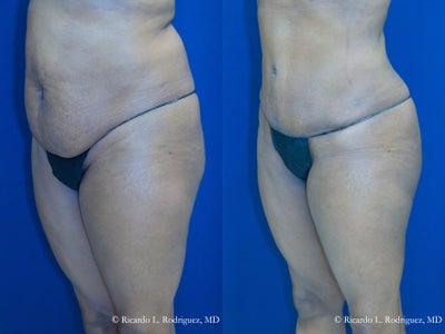 Tummy Tuck - Sixty year old African American female had an abdominoplasty, liposuction to her flanks and scapular with fat grafting to her buttocks. The most common procedure that is performed with the Brazilian butt lift is the tummy tuck. With IV anesthesia, the two procedures can be safely combined. The abdominoplasty, or tummy tuck, actually enhances the effect of the Brazilian butt lift, as your tummy and waist line are trimmer. When you combine the two together, it is a dramatic transformation.