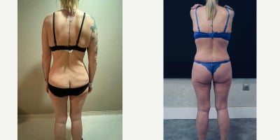 35-44 year old woman treated with Mommy Makeover - 360 lipectomyFDLAbdominal repairMons liftBreast Augmentation