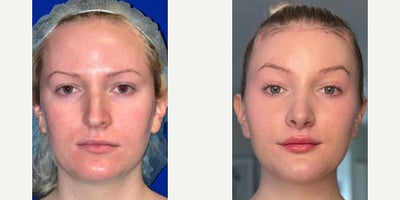 18-24 year old transgender woman treated with Facial Feminization Surgery - Facial Feminization Surgery: Hairline advancement Type III forehead and orbital contouring Brow lift Rhinoplasty V-line jaw contouring Tracheal shave (reduction of Adams apple) Fat grafting to the upper cheeks and lips Upper lip lift