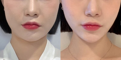 25-34 year old woman treated with Lipodissolve - Fat-dissolving injections to contour the facial line