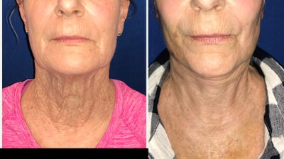 55-64 year old woman treated with Facelift - This woman had loose skin on her neck. We did a minifacelift and neck lift in the surgi-suite without the patient going to sleep. She did very well. Our goal is a smooth and natural look. Focus on the midline anterior neck. We will post further photos as she continues to heal! There is still significant bruising and swelling at this stage.