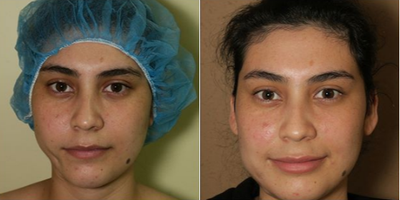 Woman treated with Facial Fat Transfer - This young lady was involved in a horrible accident which left herscars. Fat transfer was used to correct that