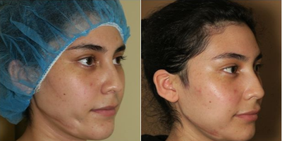 Woman treated with Facial Fat Transfer - This young lady was involved in a horrible accident whichleft herscars. Fat transfer was used to correct that