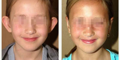 Woman treated with Ear Surgery - Woman treated with Ear Surgery