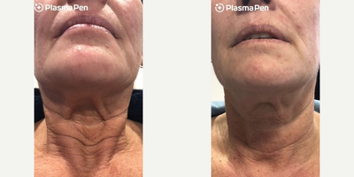 Woman treated with PlasmaPen - Woman treated with PlasmaPen