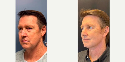 Man treated with Eyelid Surgery - Man treated with Deep Plane Facelift, Deep Plane Neck Lift, Facial Fat Transfer, Eyelid Surgery through upper blepharoplasty and lower blepharoplasty, and subtle Brow Lift.