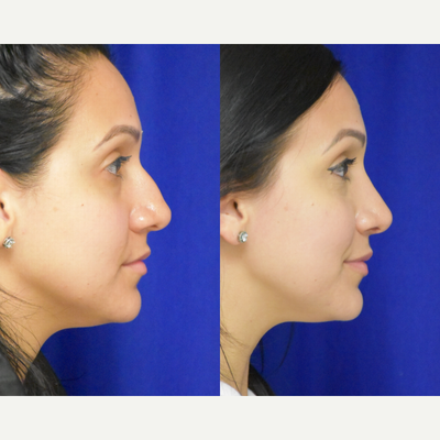 2035 - 25-34 year old woman treated with Rhinoplasty