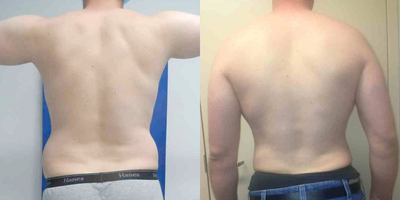 35-44 year old man treated with Tumescent Liposuction - Male lipo contouring awake