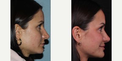 25-34 year old woman treated with Rhinoplasty - Rhinoplasty B&A