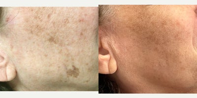 65-74 year old woman treated with PicoWay - A 74-year-old patient underwent six treatments of PicoWay laser to address a stubborn dark spot on her face. One month after the final session, the results show a significant lightening of the spot, with her skin appearing smoother and more even-toned.
