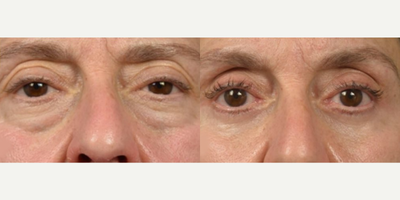 Woman treated with Eyelid Surgery - This patient in follow up, 6 months after her lower blepharoplasty with micro-droplet fat injections procedure.