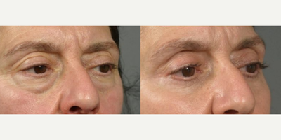 Woman treated with Eyelid Surgery - This patient in follow up, 6 months after her lower blepharoplasty with micro-droplet fat injections procedure.