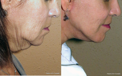 neck lift - Neck lift procedure - usually performed under sedation or local anesthesia.