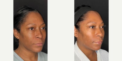 40 year old female: Full Face Balancing and Rejuvenation - 40 year old female wanted to look her best for her upcoming birthday. Aligning with her goals and budget, we treated her with hyaluronic acid dermal fillers and neuromodulators (Botox and Dysport) for her beautiful result.Cheek balancing, chin filler, jawline filler, lip filler, and upper face Botox