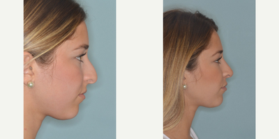 18-24 year old woman treated with Rhinoplasty - Patient with concerns of a droopy tip, hanging columella, and hump. Primary rhinoplasty techniques included hump reduction, osteotomies, caudal septal extension graft and tip onlay graft.